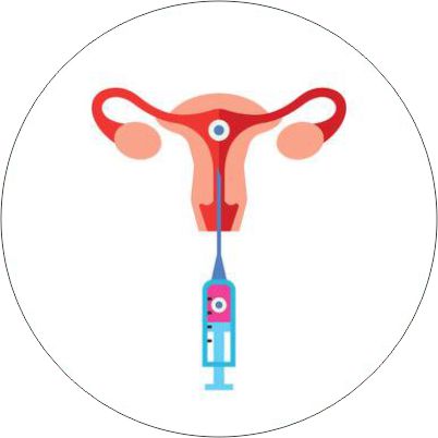 Embryo transfer