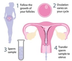IUI Treatment in Bangalore